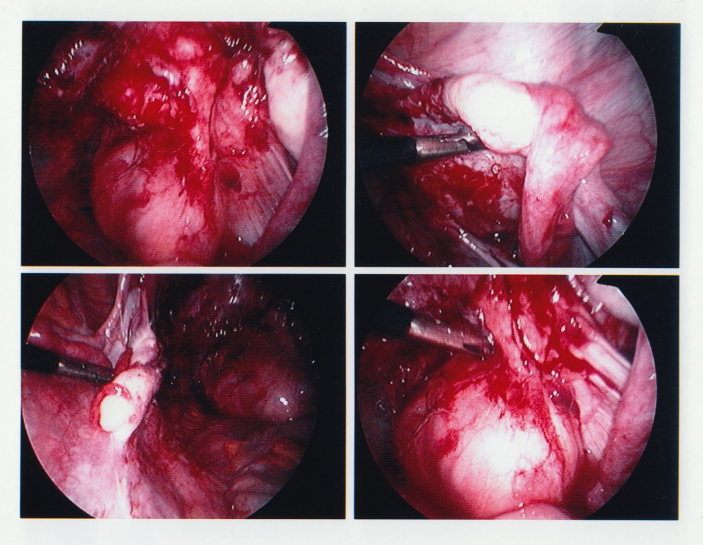 Endometriosis stage 4 (5) - bloody lesions are smeared all over the inside of the pelvic walls and organs