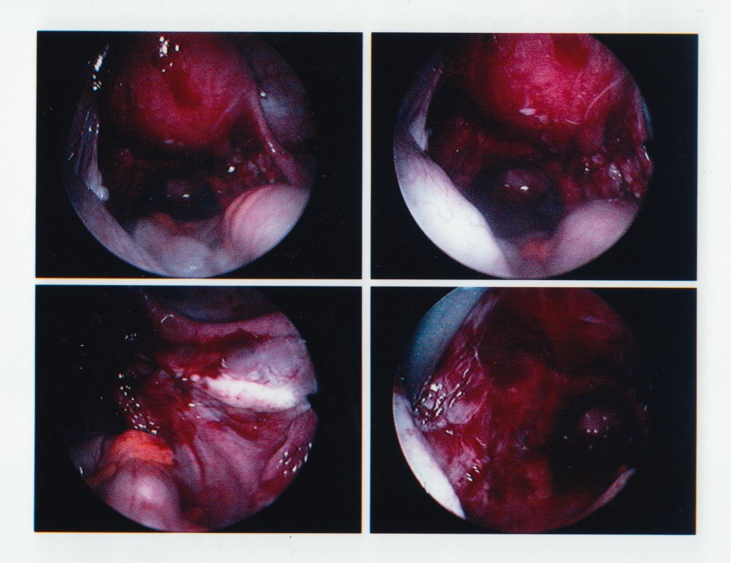 Endometriosis stage 4 (5) - bloody lesions are smeared all over the inside of the pelvic walls and organs